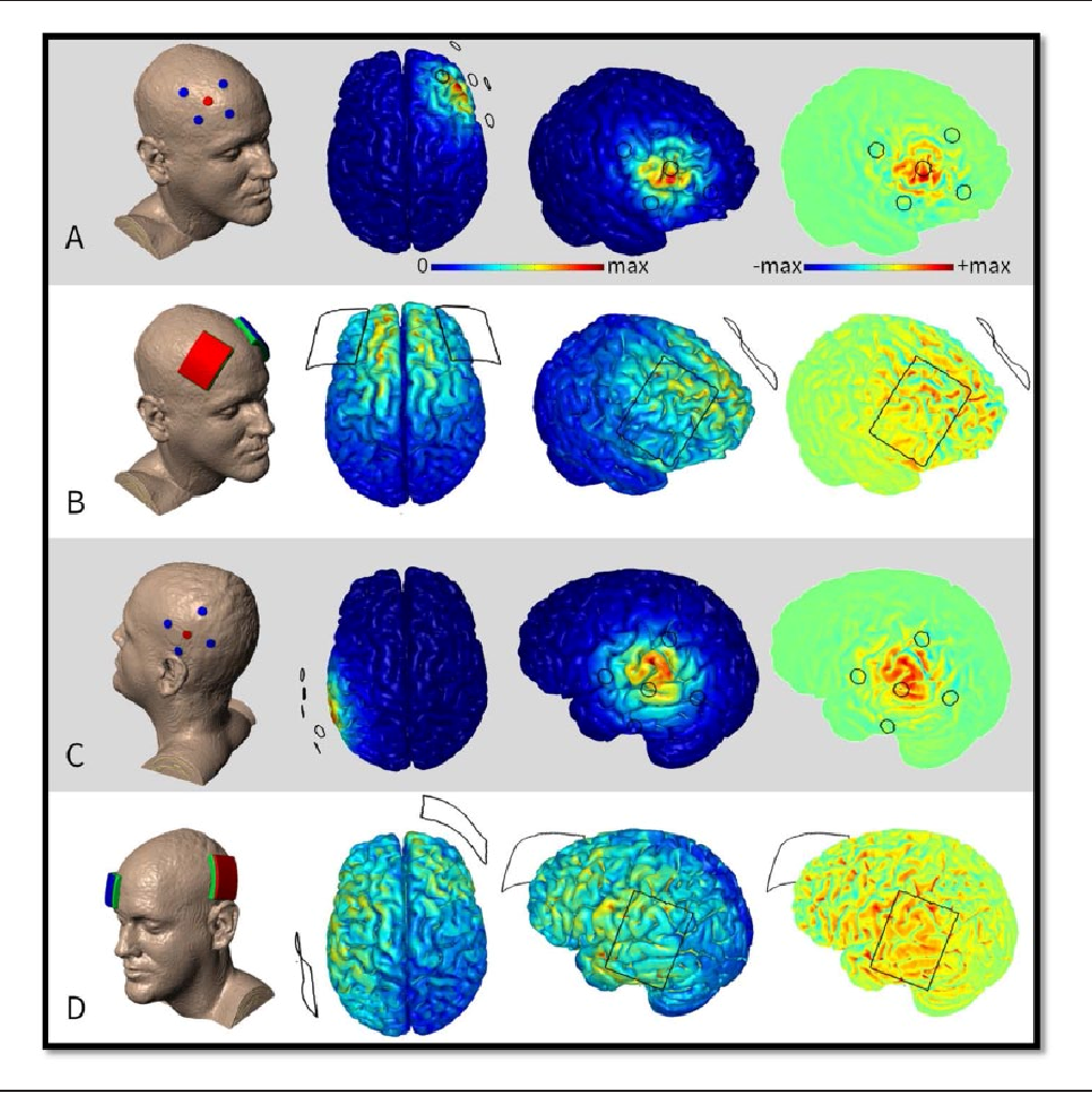 TDCS